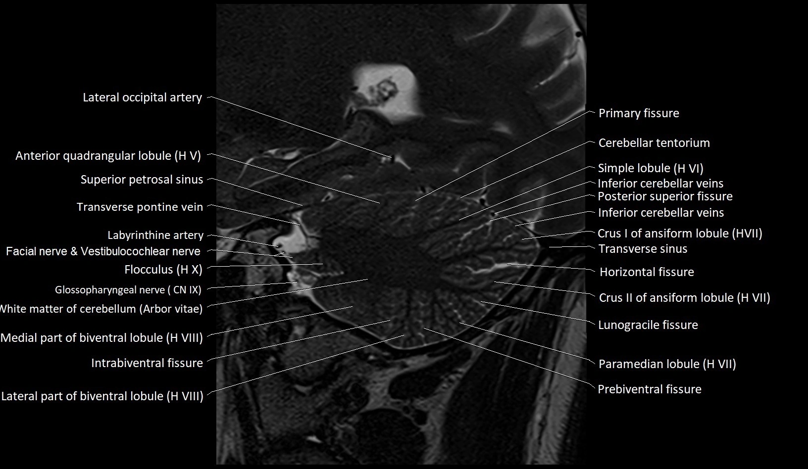 MRI Cerebellar anatomy sagittal High-resolution labelled image 18.webp